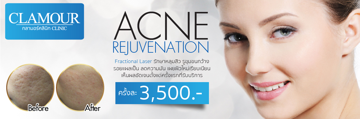 Acne Rejuvenation